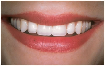 After Implant