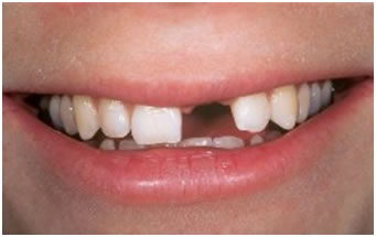 Before Implant