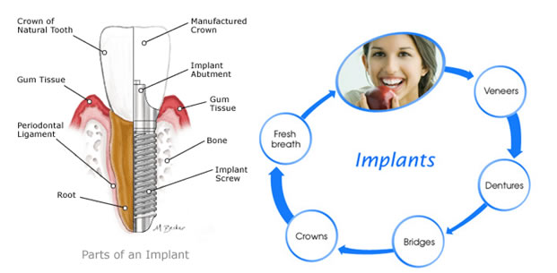 Dental Implant Method