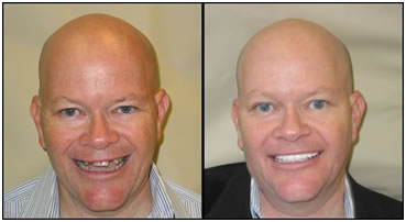 Implants - Before and After