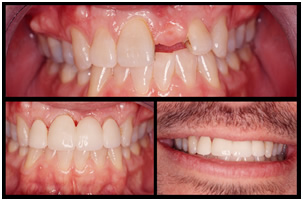 Implants - Tooth Replacement